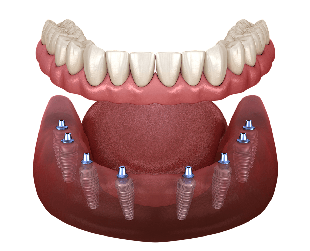 ALL ON 8 Dental Implants