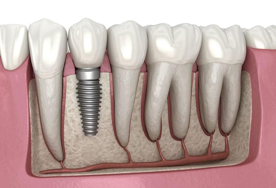 Dental Implant Reviews