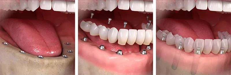 Full Mouth Dental Implants