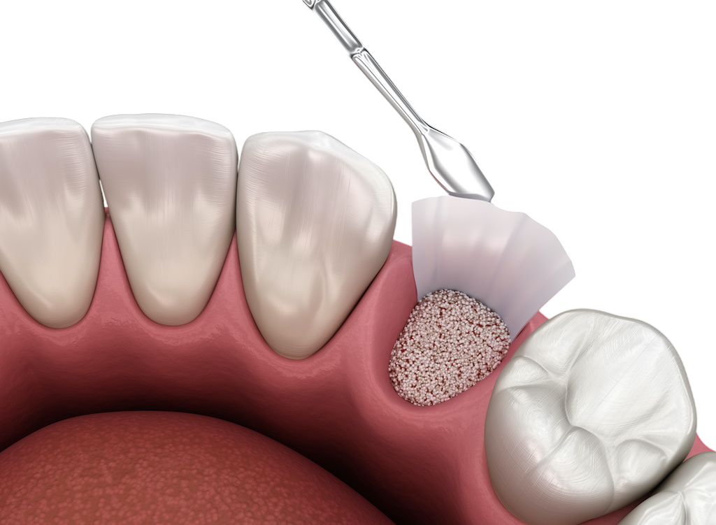 Bone Grafting Procedure