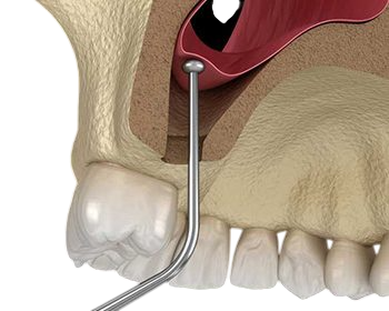 Sinus Lifting Procedure