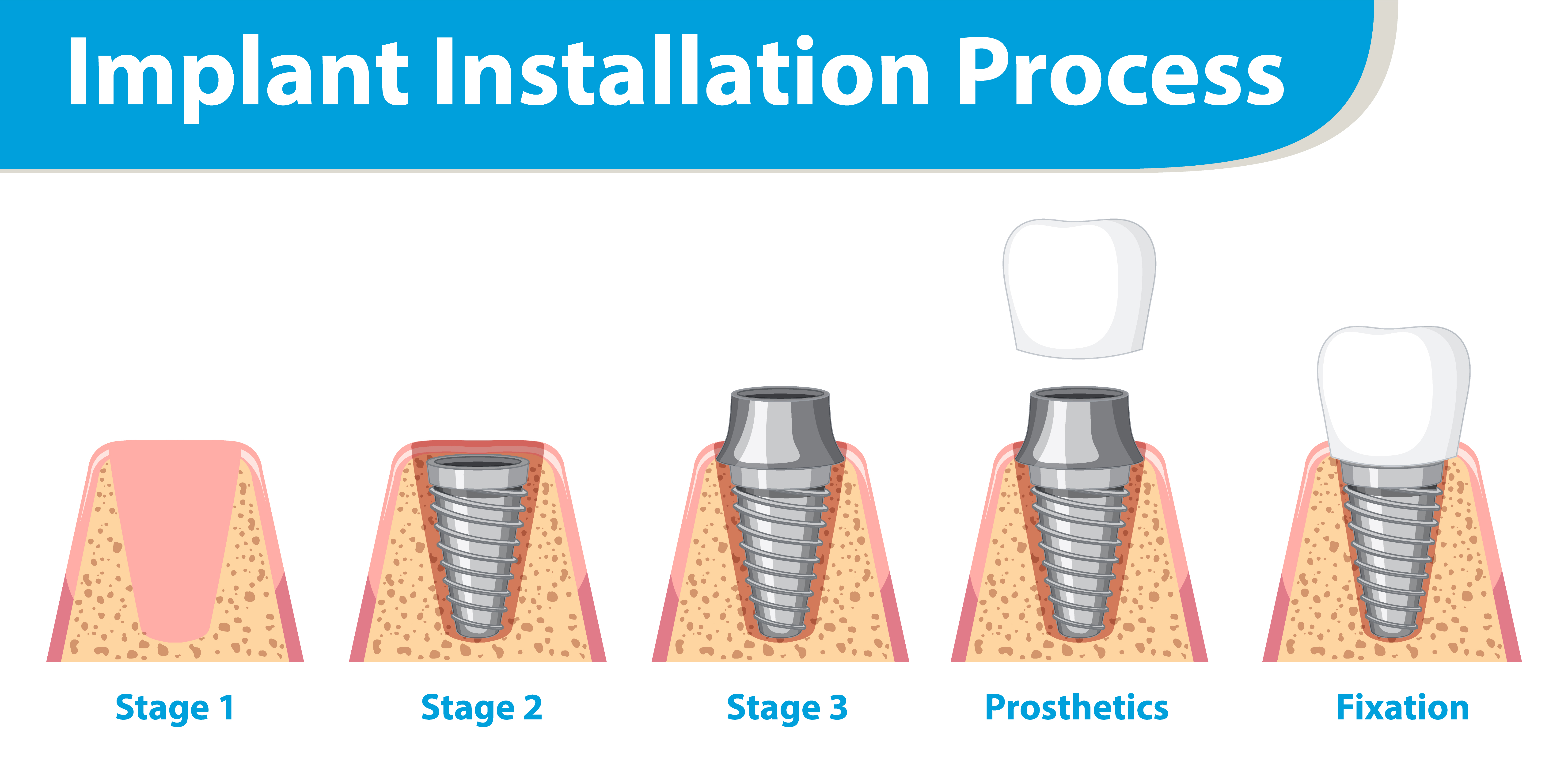 Dental Implant Process - 4 Steps: Implant insertion, Bone healing, Abutment placement, Crown placement