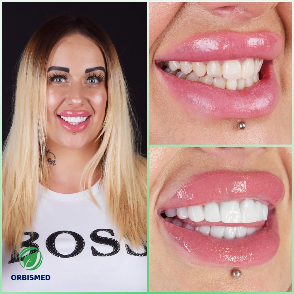 Veneers Package Turkey – OrbisMed Clinics